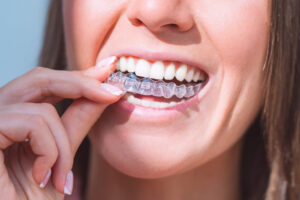 dental aligners