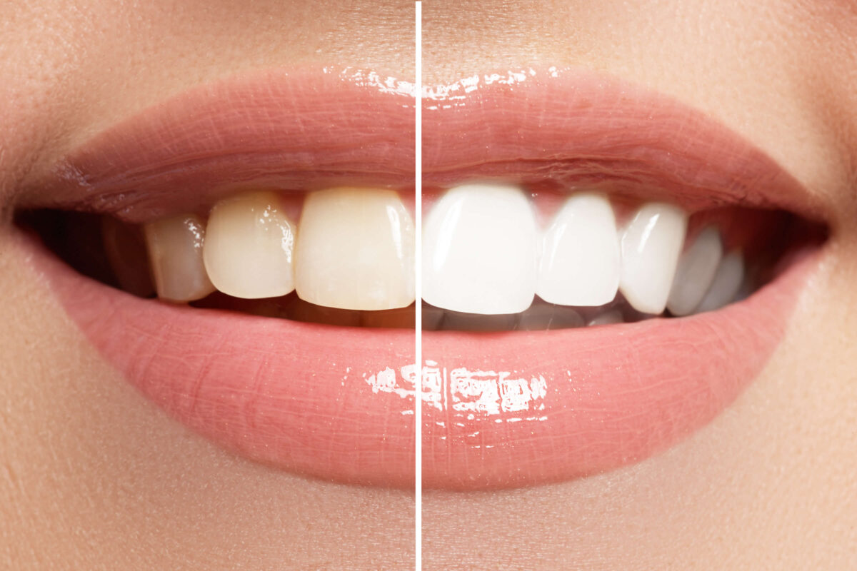 Up close photo of the before/after teeth whitening